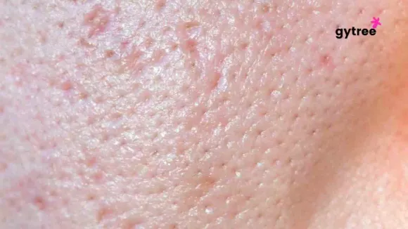 Open pores on face: How to manage them!