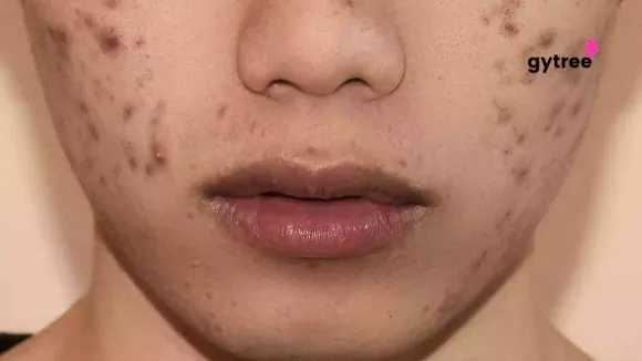Acne due to makeup: Navigating makeup for clear skin