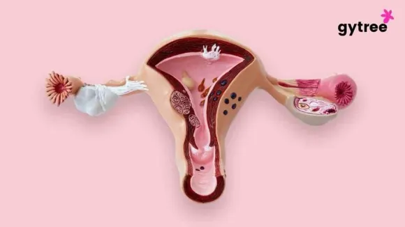 “The Complete Guide to unravel the intricate web of the symptoms causes and treatment of Polycystic Ovary Syndrome"