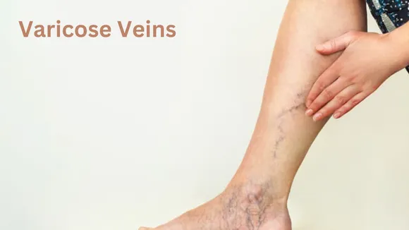 varicose veins during menopause