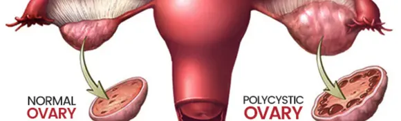 Pcos 0000. png