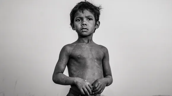 Malnutrition कुपोषण 