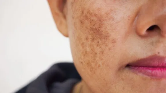 Never Ignore These Warning Signs Of Skin Cancer