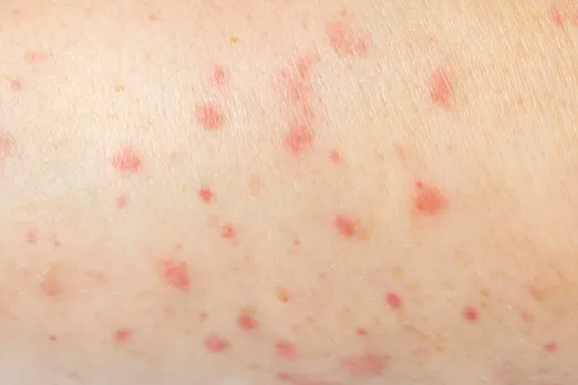 Red bumps