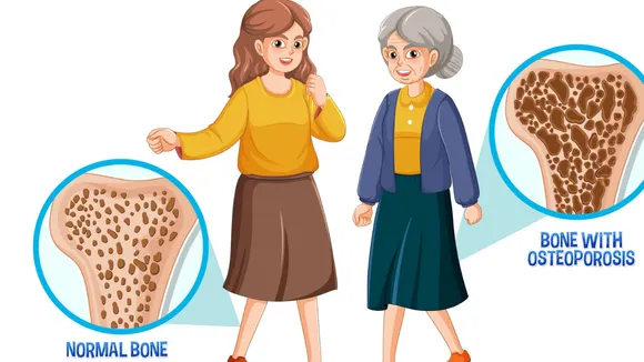 Osteoporosis