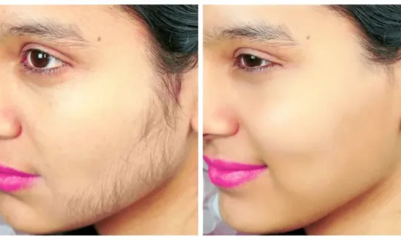Follow These 5 Easy Methods To Remove Unwanted Hair From Face