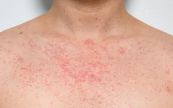HEAT RASH