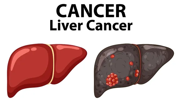 What Are The Causes Of Liver Cancer And How To Identify It
