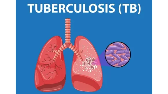 These Are The 5 Symptoms Of Having TB, Let's Find Out