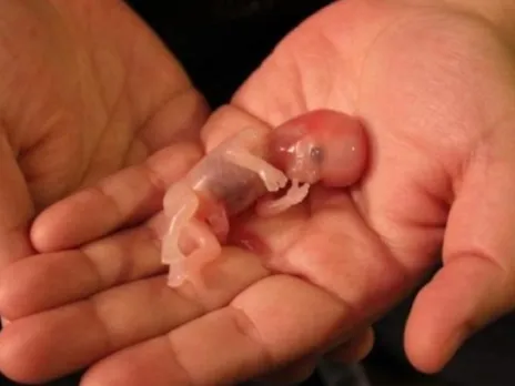 miscarriage (CNC pathlab).jpg