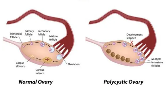 PCOS (Pinterest).png