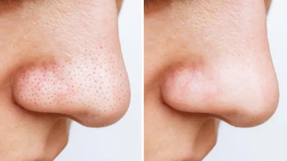 black heads
