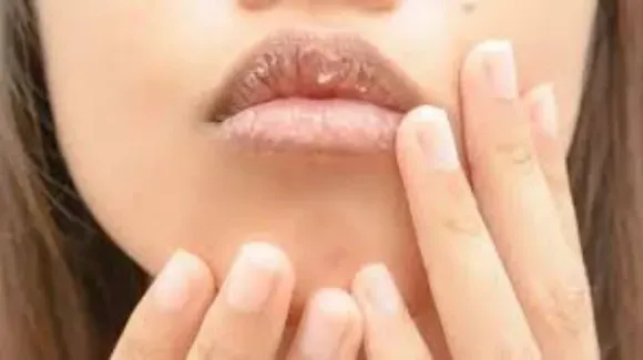 Dark Lips remedies 