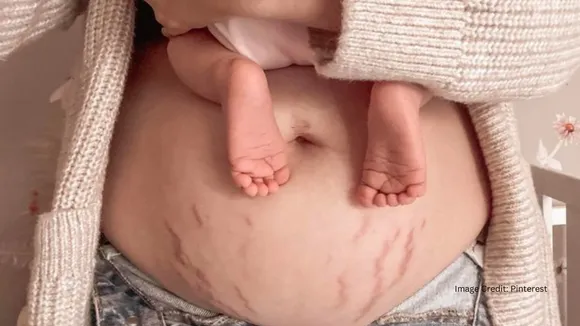 How To Prevent Strech Marks