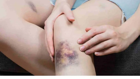 Blue Marks On The Skin During Period