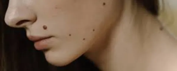 How To Reduce Mole Marks From Face 