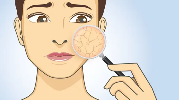 Cure Of Rough Skin