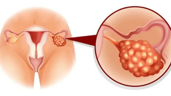 Ovarian Cyst (Pinterest).png