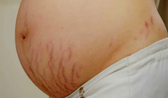Stretch Marks (NBT)