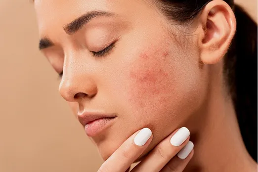 PCOS CAUSES SKIN ISSUES