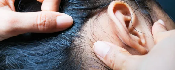 Hair Lice