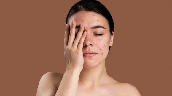 Dead Skin Cells(Freepik)