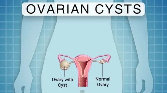 Cyst (Pinterest).png