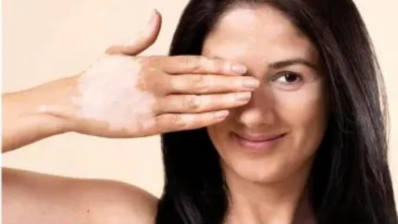 Vitiligo