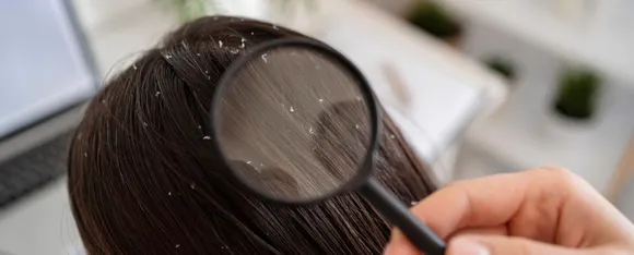 Dandruff(Image Credit Freepik)