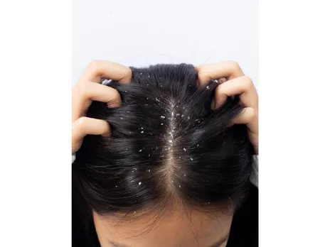 Dandruff