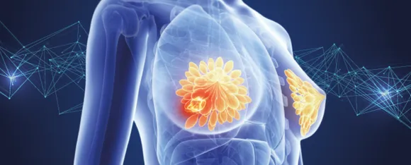 Breast Cancer img.png