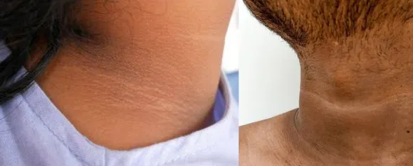 Home Remedies For Dark Neck.png