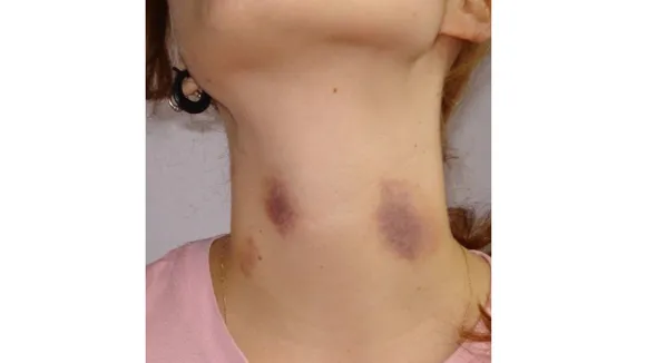 Love Bite (Wikipedia).png