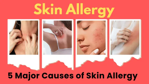 skin allergy 