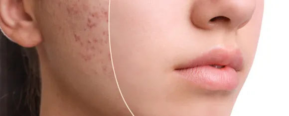 Acne Spots