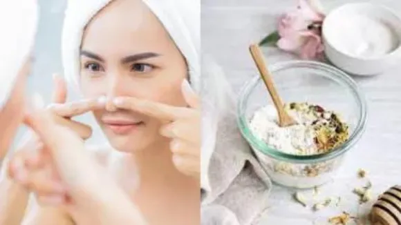 Blackheads 