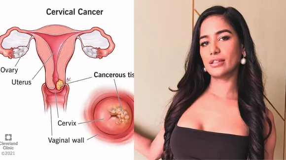 Cervical cancer