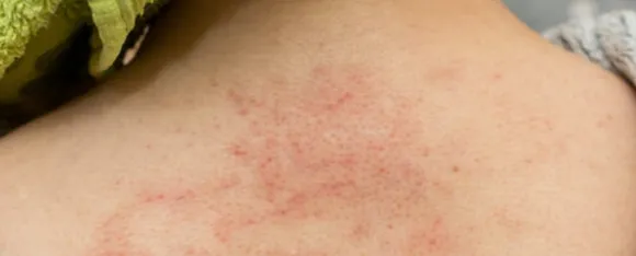 Heat Rash