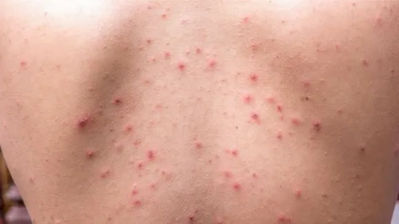 How To Reduce Back Acne