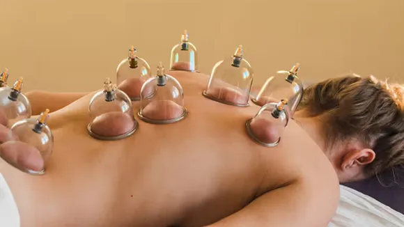 cupping therapy