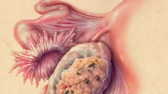 What Is Ovarian Cancer And It's Symptoms