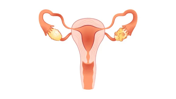 PCOD(Pristyn care).png