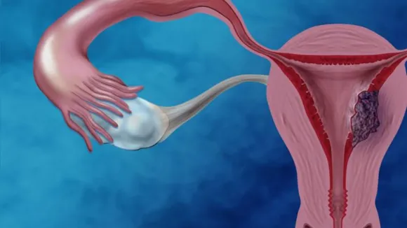 chocolate cyst