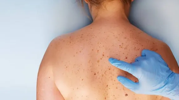 Symptoms of skin cancer