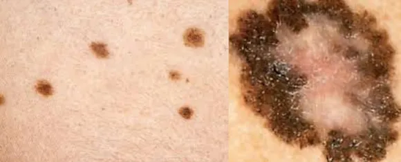 Skin Cancer 