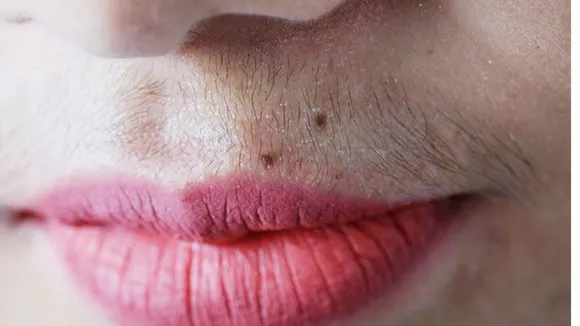 REASONS OF FACE HAIR ON WOMEN