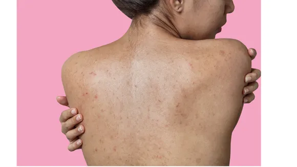 Body Acne(HealthShots).png