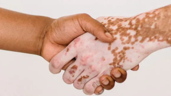 What are the reasons for the problem of vitiligo?