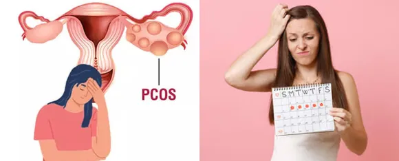 PCOS 