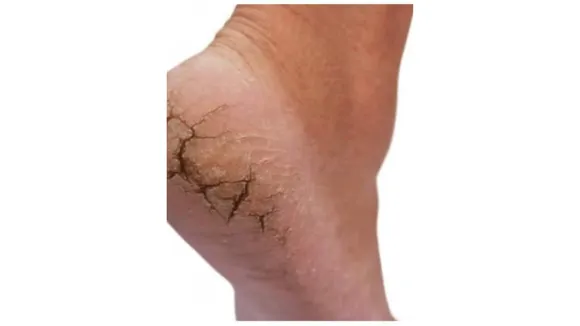 Cracked Heels(ABP News).png